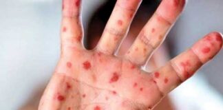 Monkey Pox In Uttarakhand