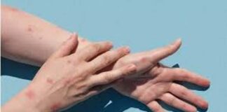 Monkeypox Case in Kerala