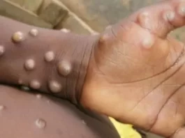 Monkeypox